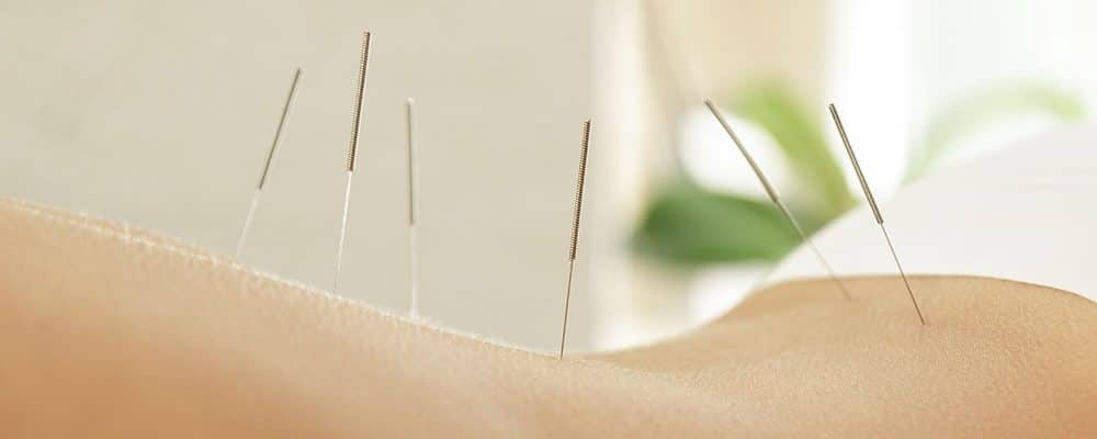 Akupunktur gegen Rauchen
